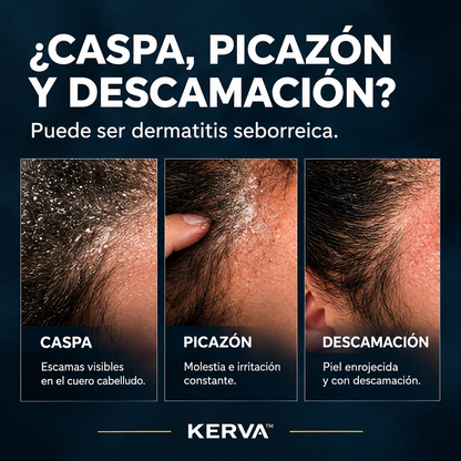 KERVA™ | Crema Antifúngica Permanente contra la Caspa y la Dermatitis Seborreica