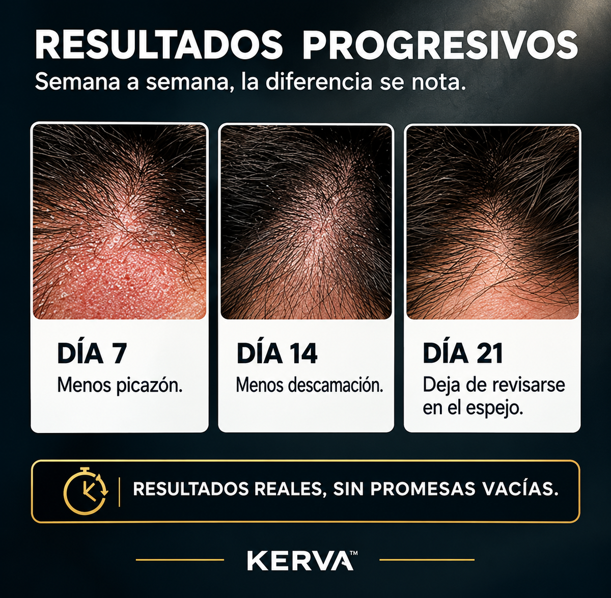 KERVA™ | Crema Antifúngica Permanente contra la Caspa y la Dermatitis Seborreica