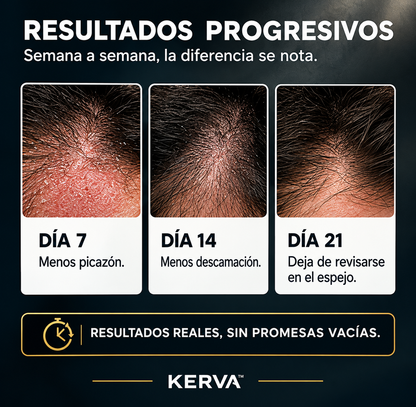 KERVA™ | Crema Antifúngica Permanente contra la Caspa y la Dermatitis Seborreica